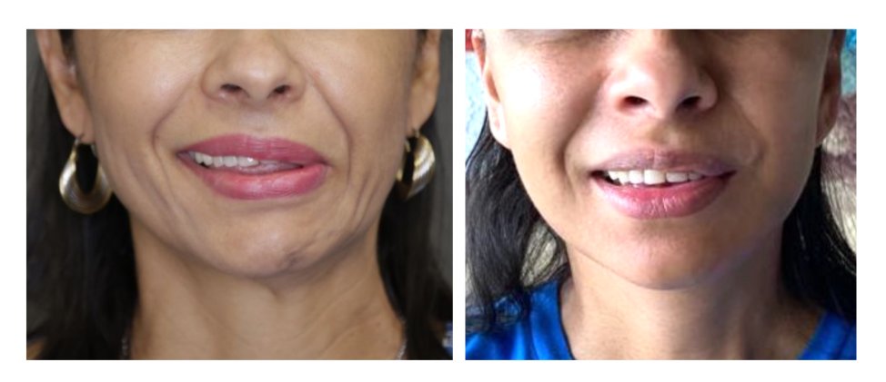 NewYorkFPC's tweet image. Before: Young woman with #synkinesis after #BellsPalsy
After: Selective neurectomy - a procedure that gives a more natural smile by removing the negative vectors.
Notice the increase in dental show, the upturned corner of the mouth, smoother neck and more natural smile!
