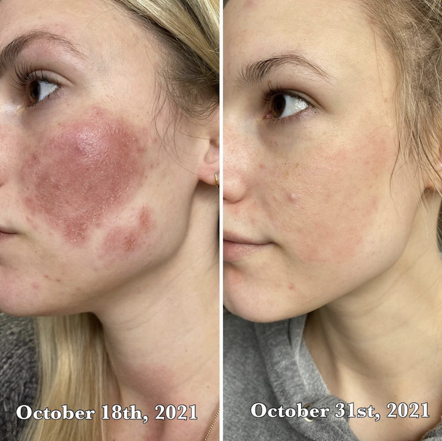 OmniluxLED's tweet photo. Omnilux delivers real results. “My eczema was over 102° on my face, it was itchy, oozy, and unbearably uncomfortable. Two weeks later, I hardly notice it and I feel like I can finally breathe again. This product worked better than anything else I’ve ever tried.” https://t.co/ITiNUaMhP8