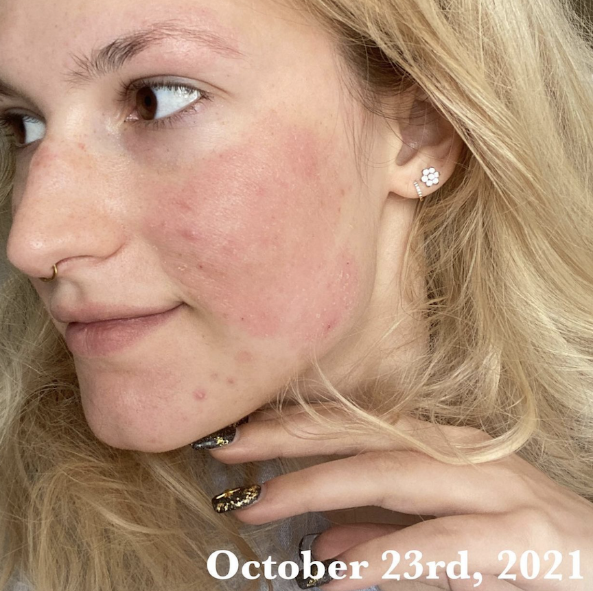 Omnilux delivers real results. “My eczema was over 102° on my face, it was itchy, oozy, and unbearably uncomfortable. Two weeks later, I hardly notice it and I feel like I can finally breathe again. This product worked better than anything else I’ve ever tried.”