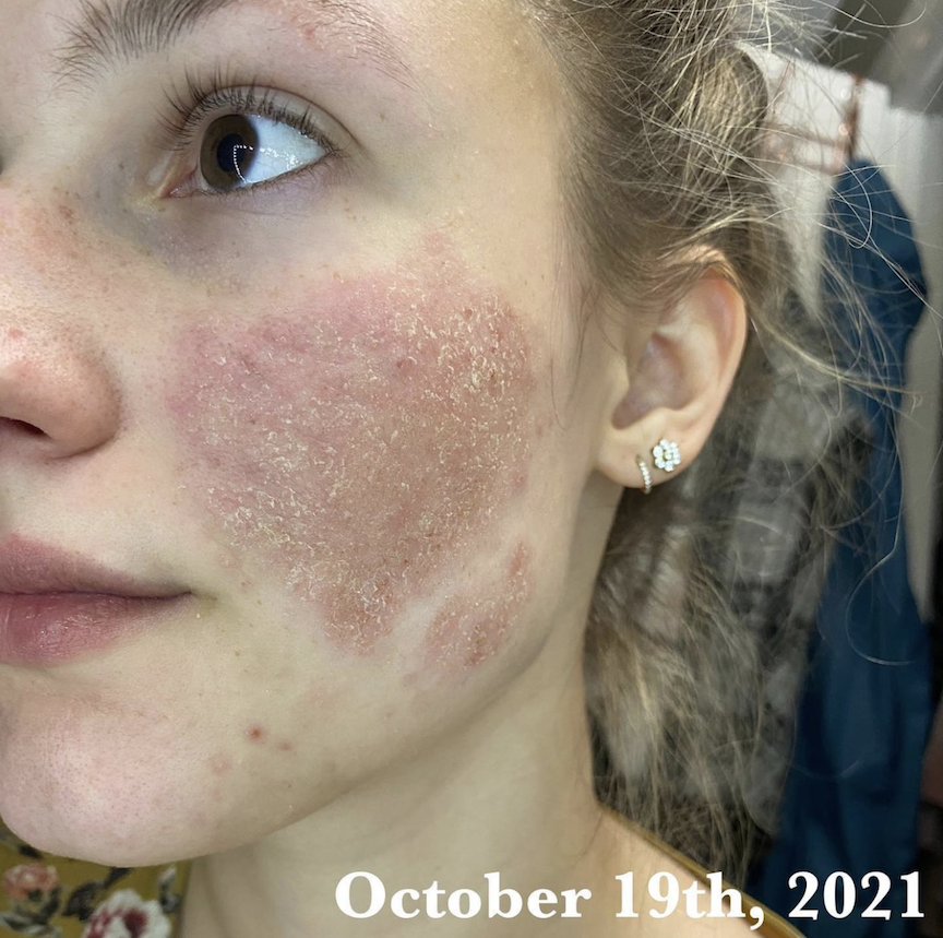 OmniluxLED's tweet photo. Omnilux delivers real results. “My eczema was over 102° on my face, it was itchy, oozy, and unbearably uncomfortable. Two weeks later, I hardly notice it and I feel like I can finally breathe again. This product worked better than anything else I’ve ever tried.” https://t.co/ITiNUaMhP8