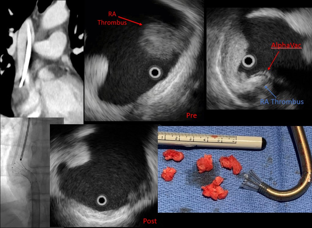 University of Cincinnati Interventional Radiology (@uc_vir) on Twitter photo Successful suction thrombectomy of Port-catheter associated RA subacute/chronic thrombus in patient with PFO and right-left shunt using #AlphaVac device and #IVUS. No reperfusion needed. With Dr. Zhang <a href="/Lulu_Zhang1049/">Lulu Zhang</a> <a href="/UCRadRes/">UCRadRes</a> <a href="/SIRspecialists/">Society of Interventional Radiology</a> Successful suction thrombectomy of Port-catheter associated RA subacute/chronic thrombus in patient with PFO and right-left shunt using #AlphaVac device and #IVUS. No reperfusion needed. With Dr. Zhang <a href="/Lulu_Zhang1049/">Lulu Zhang</a> <a href="/UCRadRes/">UCRadRes</a> <a href="/SIRspecialists/">Society of Interventional Radiology</a>