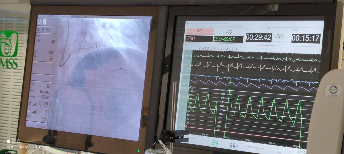 Abcsm74's tweet photo. 🧔🏻 65 a. #RadialFirst 7fr. DA #Bif 2DX #Culotte inverso 🫀👏🏻👏🏻😲🧐🤔😷🇲🇽

#TeamMacGregor #TeamComplex 
@Josema1P @cardioelihu @Abcsm74 @alejandramg1991
@latambifclub @smexcardiologia @SOLACI3 https://t.co/WGZTRo51Gw
