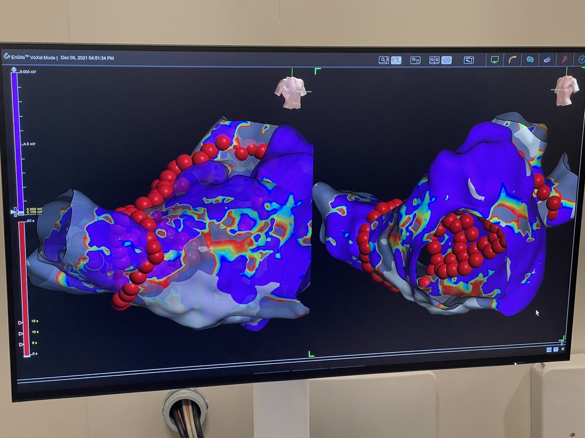 Anil Rajendra (@anilrajendra1) on Twitter photo First experience with Ensite X. Improved stability and catheter tracking. Omnipolar technology is impressive! #EPeeps <a href="/AbbottCardio/">Abbott Cardiovascular</a> First experience with Ensite X. Improved stability and catheter tracking. Omnipolar technology is impressive! #EPeeps <a href="/AbbottCardio/">Abbott Cardiovascular</a>