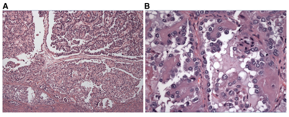 An overview of the pathologic diagnosis/differential diagnosis of high grade endometrial carcinoma and 
the TCGA classification of endometrial cancers by Dr. Wenxin Zheng at clinicalkey.com/service/conten…