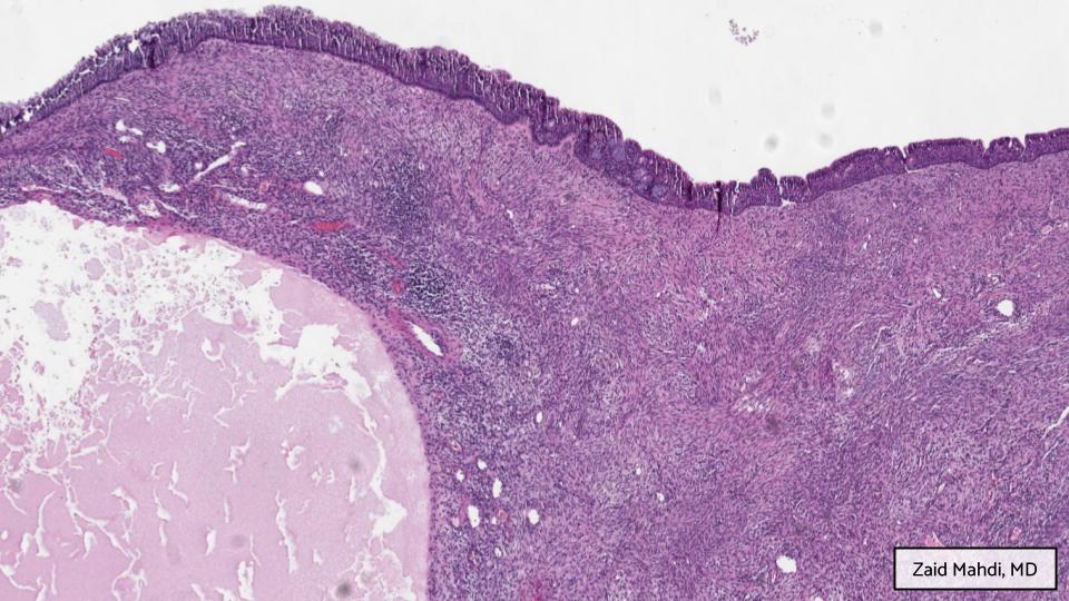 GAPathologists's tweet photo. GAP Case of the Month #5:
57βοΈ w/ persistent nasal congestion & fullness, refractory to nasal sprays. Imaging showed a frontoethmoidal lesion in the sinonasal area with possible skull base erosion.
By: Zaid Mahdi, MD (@zaid_mahdi)
Answer the question below!
#ENTpath #GAPCoTM https://t.co/xuZ5oSjShZ