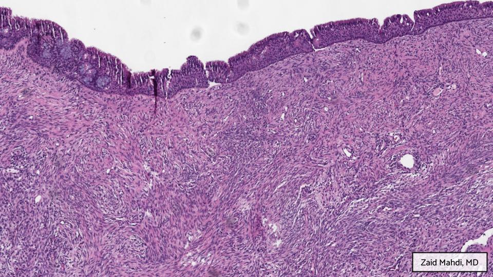 GAPathologists's tweet photo. GAP Case of the Month #5:
57βοΈ w/ persistent nasal congestion & fullness, refractory to nasal sprays. Imaging showed a frontoethmoidal lesion in the sinonasal area with possible skull base erosion.
By: Zaid Mahdi, MD (@zaid_mahdi)
Answer the question below!
#ENTpath #GAPCoTM https://t.co/xuZ5oSjShZ