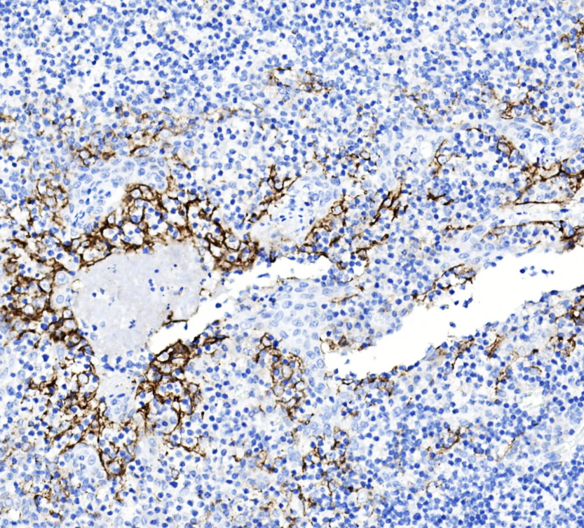 abcepta's tweet photo. Abcepta introduces PDL1 Recombinant Rabbit Monoclonal Antibody.  High selectivity, sensitivity, and reproducibility workhorse reagent for immuno-oncology research

https://t.co/UU5t4KqMkh

#cancer #immunotherapy #oncology #tcell #IHC #PDL1 https://t.co/YM3whrUg6Z