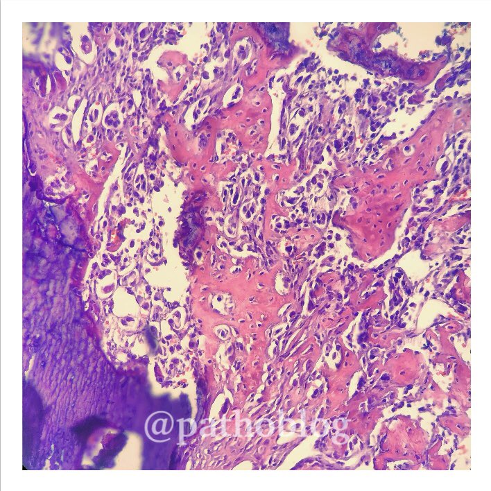 pathoblog's tweet photo. Vertebral metastasis, adenocarcinoma of the lung in L4. #pathoblog #PathTwitter #pathology #immunohistochemistry #lungpath #pulmpath #lungpathology #bonepath #bonepathology #metastasis https://t.co/oaHbK1QlmH