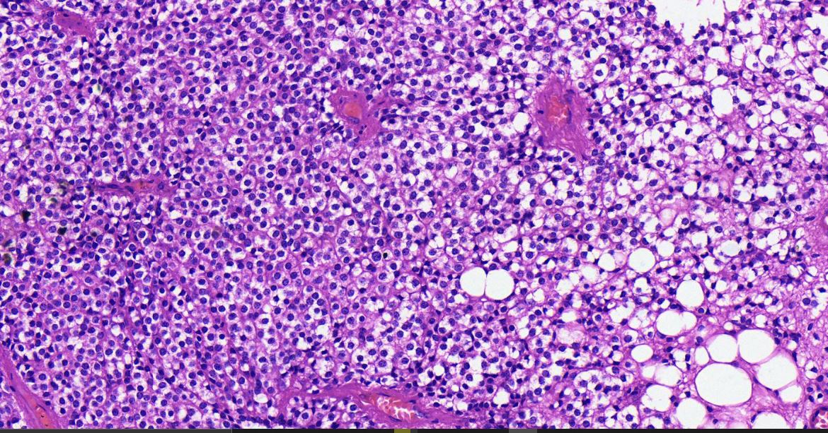 Lateral ventricle mass 
Central Liponeurocytoma 
How do we Grade this since it isnt on yet WHO?