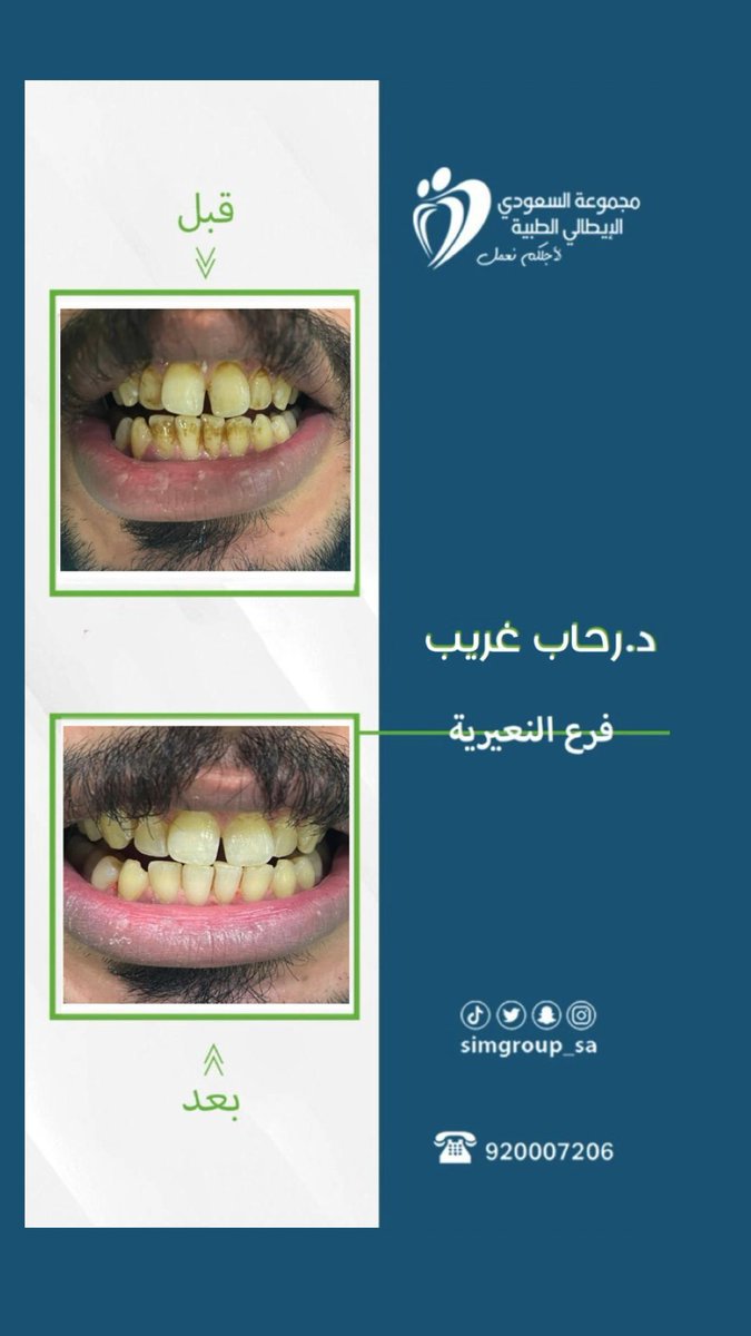simgroup_sa's tweet photo. حالة #تنظيف_اسنان لدى د. رحاب غريب في #مجمع_السعودي_الايطالي
@simgroup_sa
للأستفسار والحجوزات ☎️ 920007206
#اسنان #طبيب #تركيبات_اسنان #طب #عدسات_اسنان #zercon #hollywoodsmile #النعيرية #الدمام #حفرالباطن #الخفجي #الصرار #مليجه https://t.co/ogF8d0QZVc