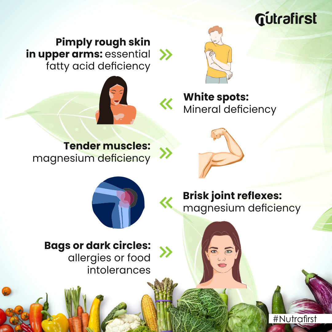 nutrafirst_in's tweet photo. A #healthy #diet can provide all a growing body needs, but the reality of our busy lifestyles and sometimes finicky eating patterns can lead to #vitamin deficiency. Knowing what to look for is part of the battle. Find more insights on - https://t.co/uosYb5B6AR
#nutrition #health https://t.co/WuAWADiZSC