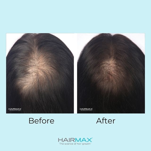 HAIRMAX　ヘアマックス　育毛サイエンス