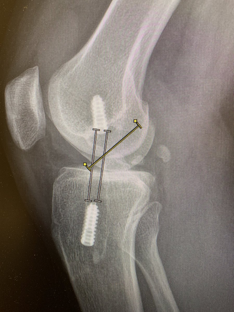 MichaelAlaiaMD's tweet photo. not sure if there is enough space for another femoral tunnel https://t.co/BLDQ9DwqcO