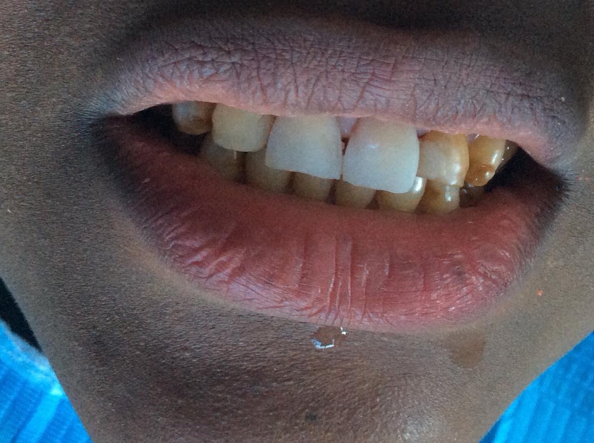 NEXTCAREDENTAL's tweet photo. Direct veneers in progressβ¦
#transformingsmiles at #nextcaredentalstudio for everything dental
Book us to revamp your smile on 0746290170
Feruzi Towers 3rd Floor Wing A https://t.co/MaaLY03Rwb