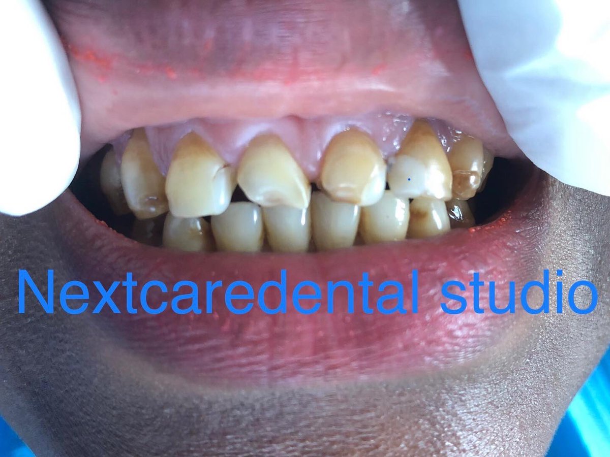 NEXTCAREDENTAL's tweet photo. Direct veneers in progressβ¦
#transformingsmiles at #nextcaredentalstudio for everything dental
Book us to revamp your smile on 0746290170
Feruzi Towers 3rd Floor Wing A https://t.co/MaaLY03Rwb