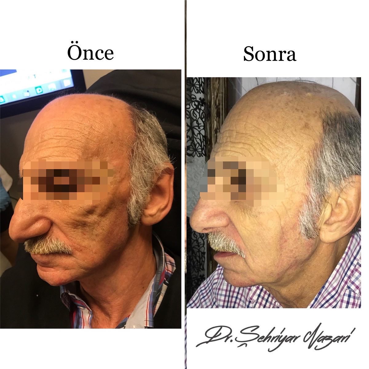 SehriyarDr's tweet photo. Whole Face Approach:
Patient who asks help from the physician does not kmow what he needs. In most of the patients, only one session intervention can not be enough. The related doctor should make a therapeutic plan and explains it to her/his patient. https://t.co/ZypmUMzg46