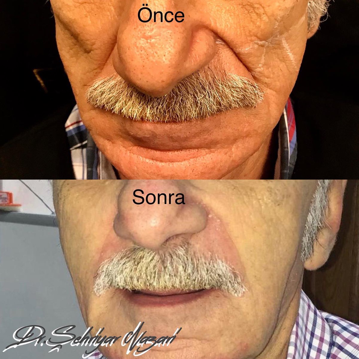 SehriyarDr's tweet photo. Whole Face Approach:
Patient who asks help from the physician does not kmow what he needs. In most of the patients, only one session intervention can not be enough. The related doctor should make a therapeutic plan and explains it to her/his patient. https://t.co/ZypmUMzg46
