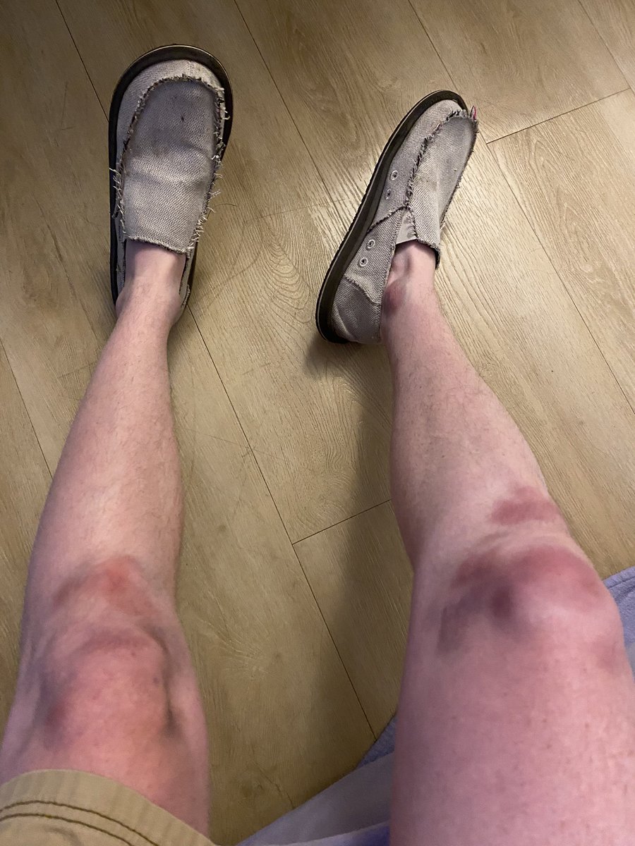 All these bruises on my knees and ankles are from the dance floor. Ugh I’m hungover #Battle4Atlantis