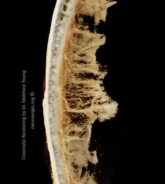 neuroangio1's tweet photo. #CinematicRendering of #SubduralHematoma membranes obtained with @SiemensHealth #DynaCT. Amazing what we can see today. #stereophotography crosseye and #anaglyph also https://t.co/x8s6Nz4elD