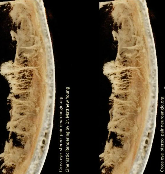 neuroangio1's tweet photo. #CinematicRendering of #SubduralHematoma membranes obtained with @SiemensHealth #DynaCT. Amazing what we can see today. #stereophotography crosseye and #anaglyph also https://t.co/x8s6Nz4elD