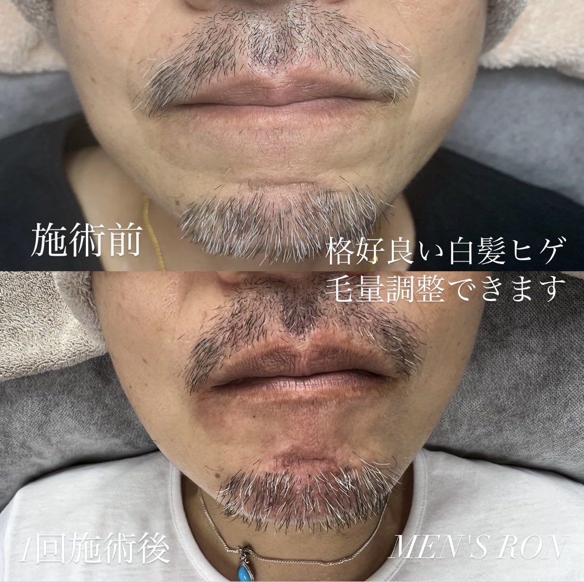 メンズ電気脱毛ron新宿 イケメン白髪ヒゲ 白髪ヒゲの毛量調整も可能です ツルツルヒゲにすること デザインヒゲ 間引いて毛量調整すること などお好み合わせて調整可能です お気軽にご相談くださいませ 男性専門 電気脱毛店 Ron新宿 メンズ電気脱毛ron新宿 イケメン白髪ヒゲ 白髪ヒゲの毛量調整も可能です ツルツルヒゲにすること デザインヒゲ 間引いて毛量調整すること などお好み合わせて調整可能です お気軽にご相談くださいませ 男性専門 電気脱毛店 Ron新宿