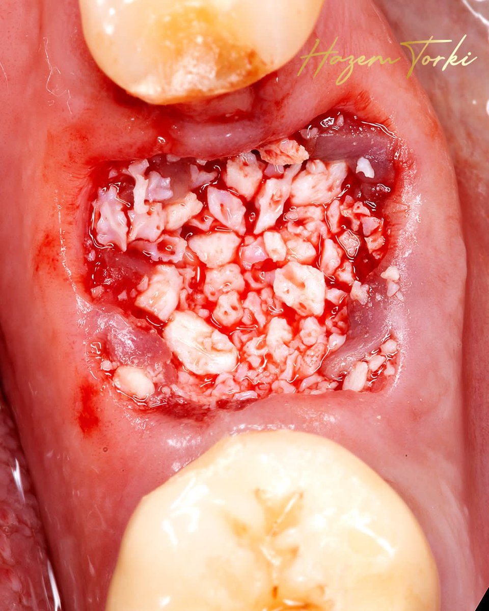 DHazemtorki's tweet image. #socketpreservation + #immediateimplant placement check full case on #instagram @Dr.hazemtorki