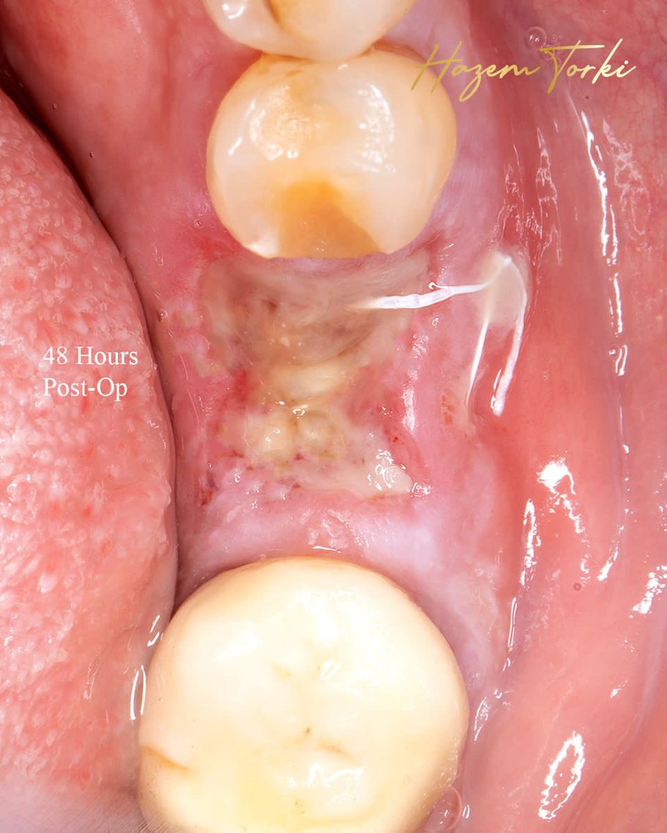 DHazemtorki's tweet image. #socketpreservation + #immediateimplant placement check full case on #instagram @Dr.hazemtorki
