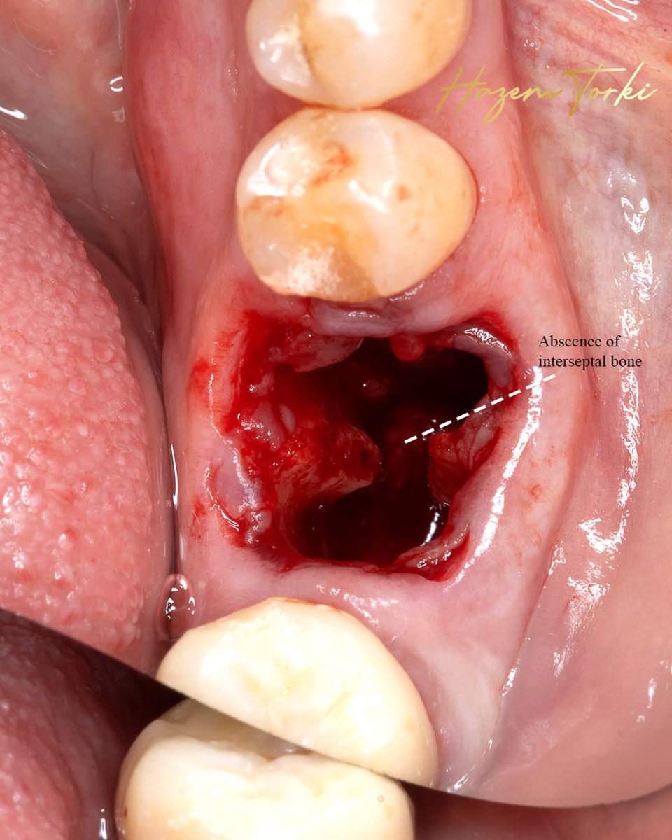 DHazemtorki's tweet image. #socketpreservation + #immediateimplant placement check full case on #instagram @Dr.hazemtorki