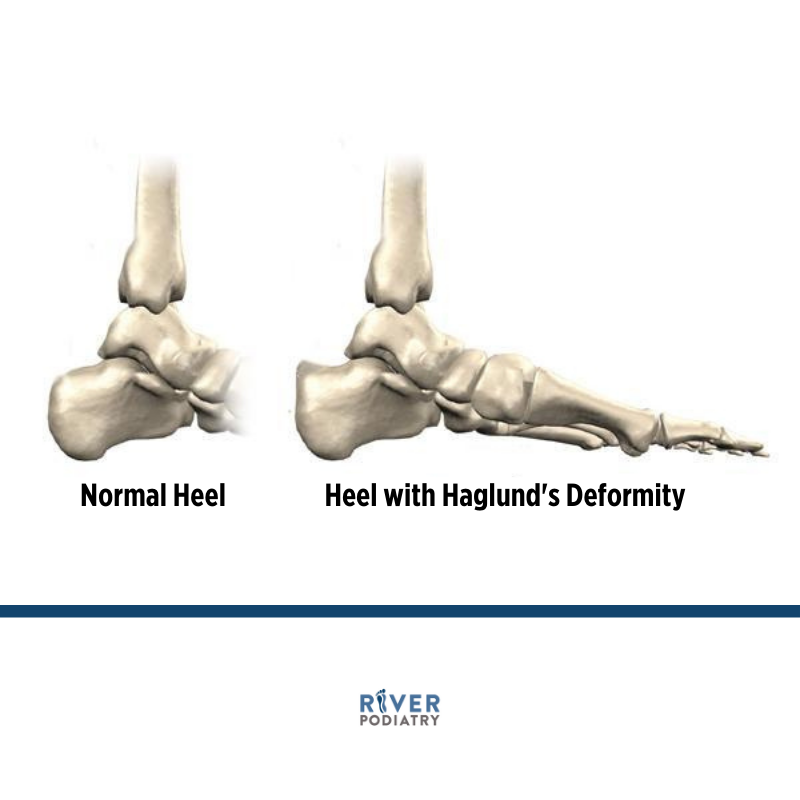 River_Podiatry's tweet photo. Haglund’s Deformity is a bony enlargement at the back of your heel. It occurs when the soft tissue near the end of the Achilles tendon becomes irritated from rubbing against your shoes. 

Click the link below to learn more. 

https://t.co/grH55AIaZY https://t.co/DWpfRjYBkH