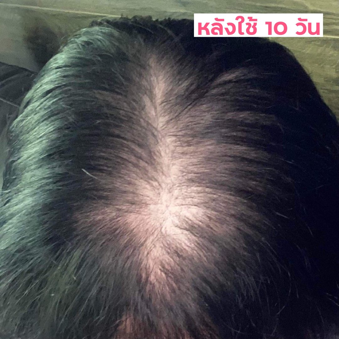 cr_ralof's tweet photo. ทุกวันนี้หลายคนมากที่เป็นโควิดแล้วเจอปัญหาผมร่วง และนี่คือตัวอย่างลูกค้าของร้านชร ที่ซื้อราลอฟไปใช้สระต่อเนื่องทุกวันตลอด 10 วัน ผลลัพธ์คือดีขึ้นมากก🥺💖 

แล้วยังมีลูกค้าอีกหลายคนเลยย ที่ทักมาบอกว่าผมยาวไวขึ้น ลูกผมขึ้นใหม่เยอะมากก ใจฟูแล้ววว🥰✨ https://t.co/zsigG51am3