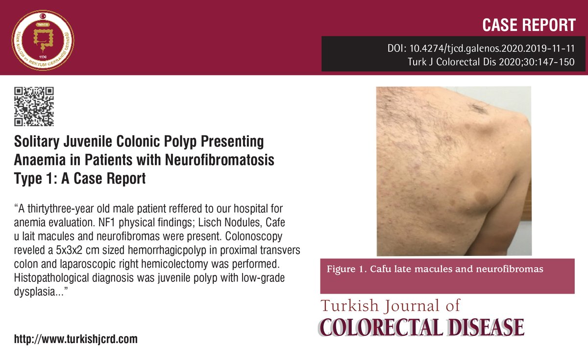 Solitary Juvenile Colonic Polyp Presenting Anaemia in Patients with Neurofibromatosis Type 1: A Case Report

“A thirtythree-year old male patient reffered to our hospital for anemia evaluation…

More: cms.galenos.com.tr/Uploads/Articl… 
#Anemia #juvenilecolonicpolyp #neurofibromatosistype1