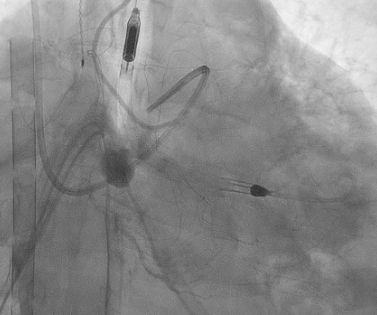 agtruesdell's tweet image. Another time #SingleAccess comes in handy: surgical cut-down axillary Impella (as part of EC-Pella) with need for same-sitting coronary angiography…