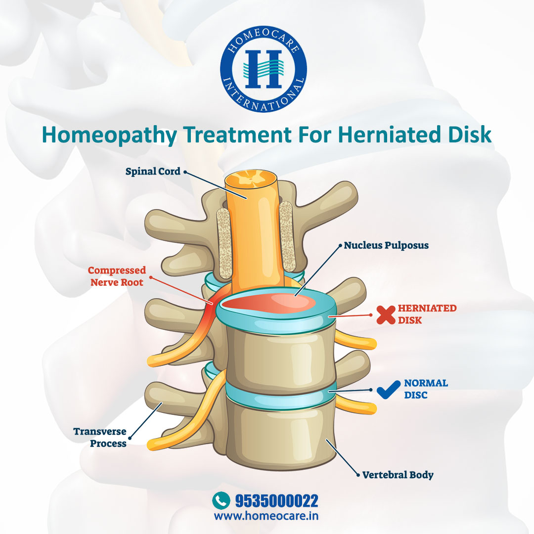 homeocareint's tweet photo. Read the below blog on homeopathy treatment for a herniated disk and get more information about constitutional homeopathy treatment for a herniated disk.

https://t.co/r57L6qlK84

#homeocareinternational #herniateddisk #herniateddisktreatment #homeopathytreatmentforherniateddisk https://t.co/28YijsHOPU