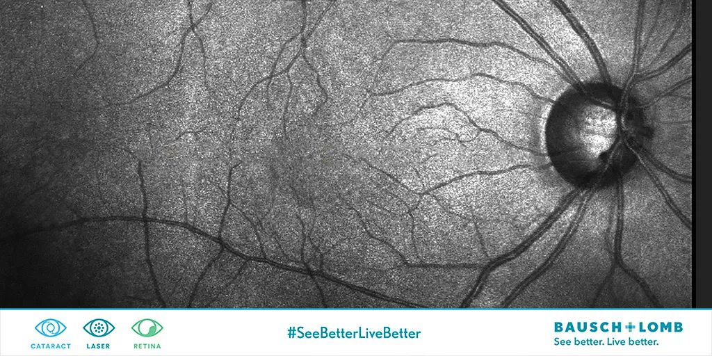 BauschSurgical's tweet photo. B+L and Clearside Biomedical announce the FDA approval of XIPERE™ which utilizes the suprachoroidal space to treat patients suffering from macular edema #TogetherWithBausch https://t.co/xEWtxFFbJW https://t.co/uREqTkMI0W
