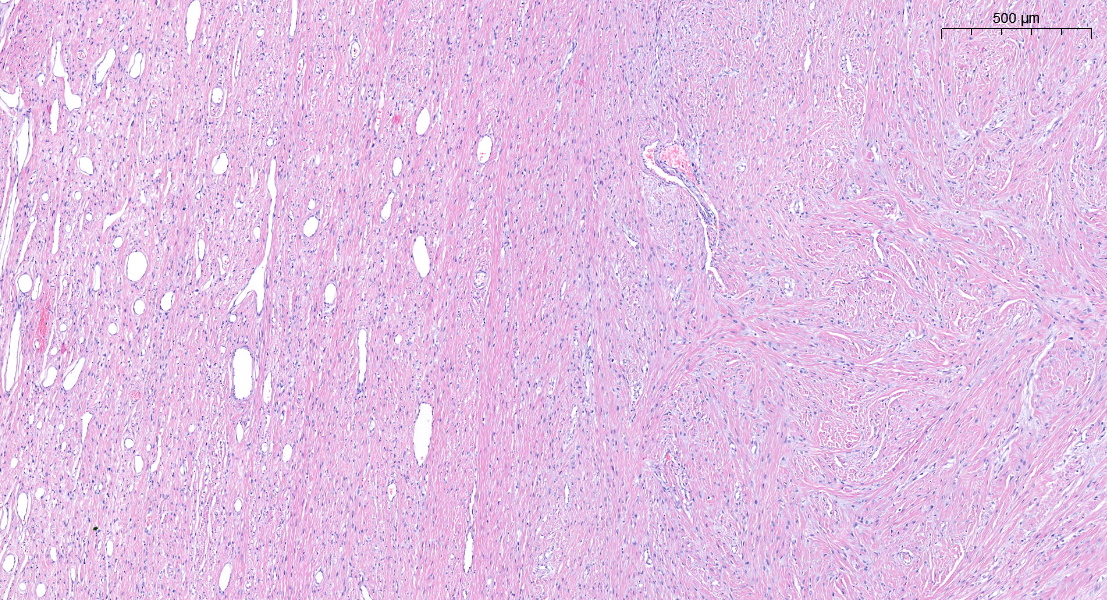 FliquiPath's tweet photo. Boy, 5 years old with a solitary mass aboute 3'4 cm in upper back. No antecedents. It looks like a biphasic lession? or it is the same with different morphology? I'm not sure totally about the name of this mass.. what do you think??
#PediPath #BSTPath #PathTwitter #pathresidents https://t.co/DcvdttWsBZ