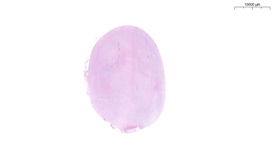FliquiPath's tweet photo. Boy, 5 years old with a solitary mass aboute 3'4 cm in upper back. No antecedents. It looks like a biphasic lession? or it is the same with different morphology? I'm not sure totally about the name of this mass.. what do you think??
#PediPath #BSTPath #PathTwitter #pathresidents https://t.co/DcvdttWsBZ
