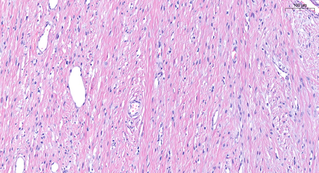 FliquiPath's tweet photo. Boy, 5 years old with a solitary mass aboute 3'4 cm in upper back. No antecedents. It looks like a biphasic lession? or it is the same with different morphology? I'm not sure totally about the name of this mass.. what do you think??
#PediPath #BSTPath #PathTwitter #pathresidents https://t.co/DcvdttWsBZ