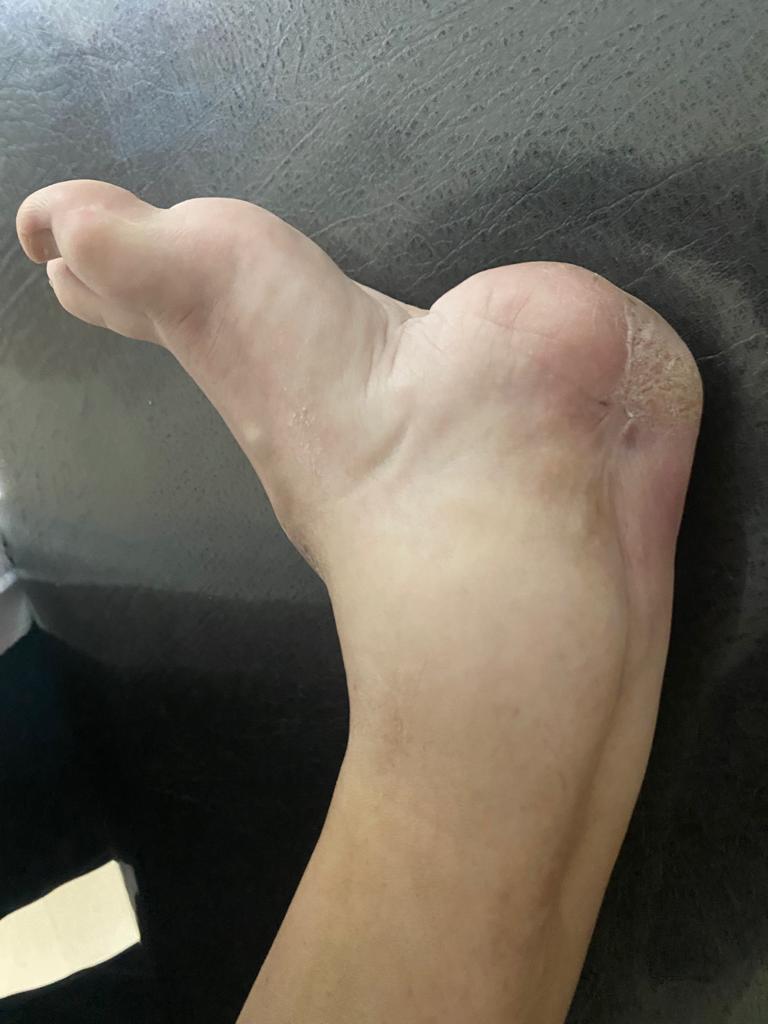 We are working on a humanitarian program in Neuquén Argentina. Here with a profoundly disabled child who has terrible consequences from a previous treatment for club foot deformity with a partial amputation of her  one foot.