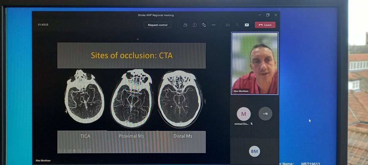 Dr Mortimer explaining imaging used for patient selection for thrombectomy, as part of our regional Stroke Nurse Practitioner day. <a href="/lucyaus15578207/">lucy austin</a> <a href="/MichaelaMcKin/">Michaela McKinney</a> <a href="/NmskNbt/">NMSK at North Bristol Trust</a> #thrombectomy