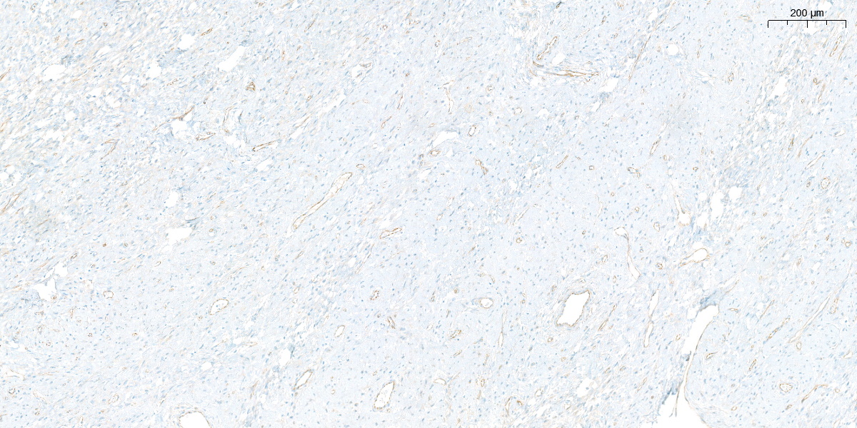 FliquiPath's tweet photo. left-beta catenin; right-CKAE1/AE3 https://t.co/hiXVOk4Fzc