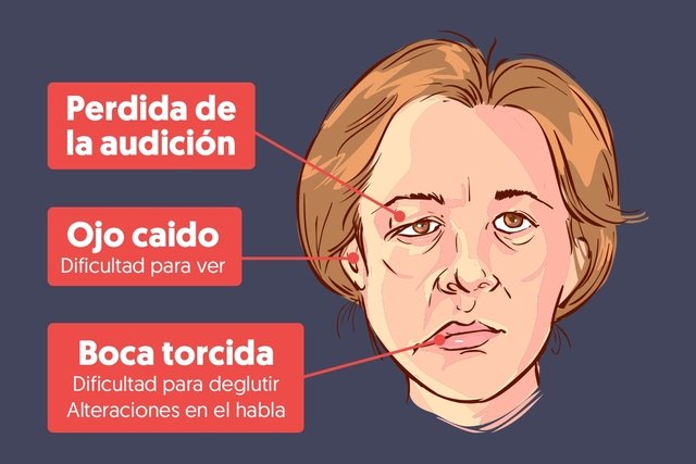 fucacsantafe's tweet photo. Después de un #ACV, una persona puede quedar con varias secuelas dependiendo de la zona del cerebro afectada, así como del tiempo que quedó sin recibir sangre esa región. La más común es la pérdida de fuerza, la cual puede terminar produciendo dificultad para caminar o hablar. https://t.co/7hdw5xd82x