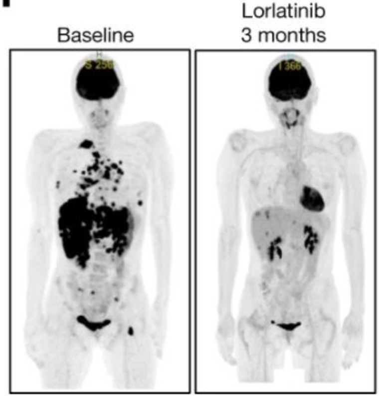 VivekSubbiah's tweet photo. 🎯🥁New druggable alteration in lung cancer 👉Another win for #PrecisionMedicine👉Discovery of a novel fusion driver, rapid bench to bedside translation
👉CLIP1–LTK fusion is an oncogenic driver in non‐small‐cell lung cancer 🫁🧬  #LCSM @Nature @OncoAlert  https://t.co/X8vt9QW8Ad https://t.co/8R6pXwMV2P