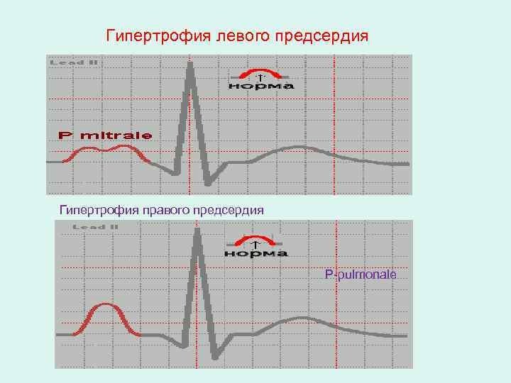 Гипертрофия предсердий причины. Экг при гипертрофии правого предсердия. Степени дилатации предсердий. Электрическая ось сердца при гипертрофии левого предсердия. Гипертрофия предсердий причины.