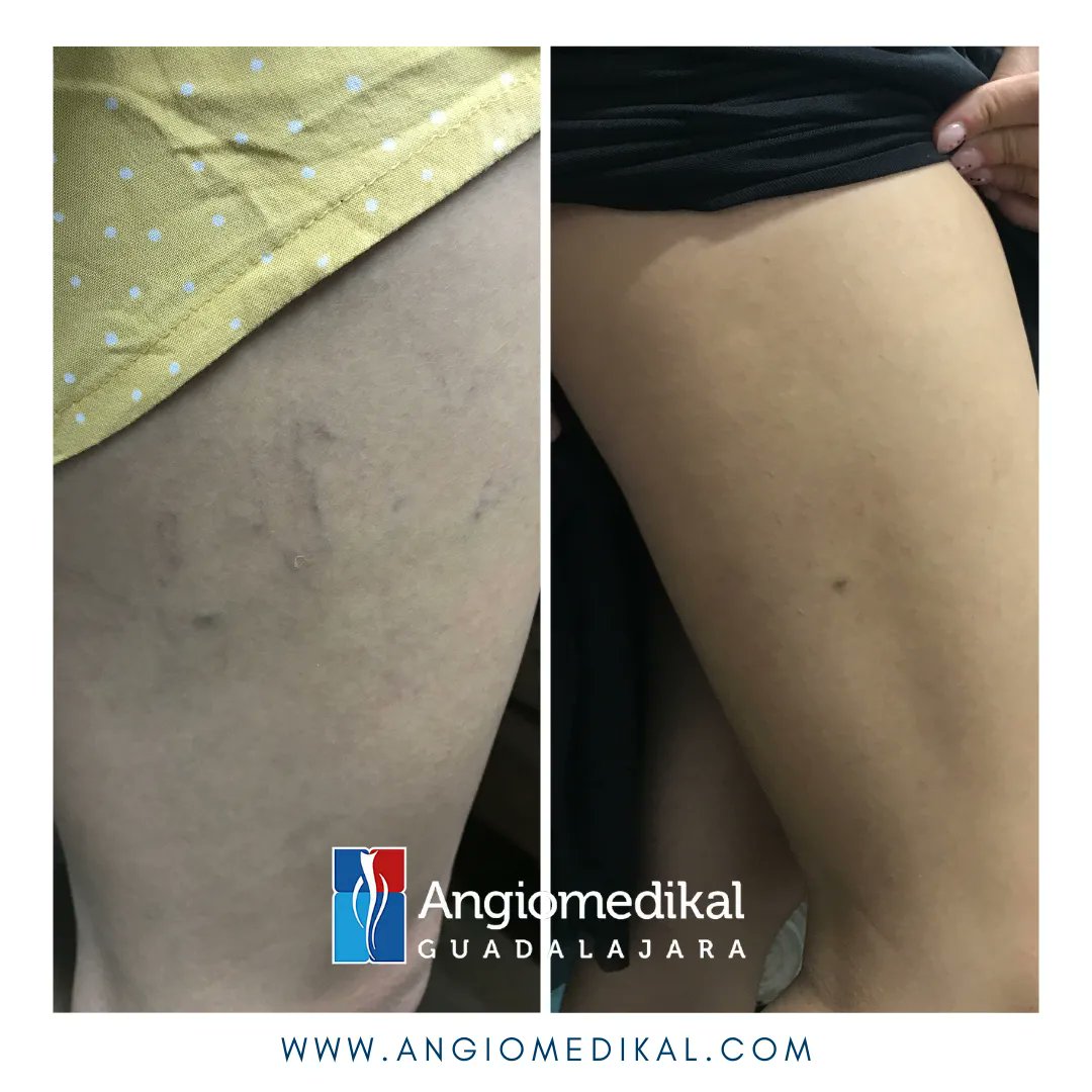angioycvascgdl's tweet photo. ✅ Resultados de Escleroterapia ⭐️⭐️⭐️⭐️⭐️
Gracias por tu confianza💜
✅Cuida tu circulación, #hazloenmanosdeexpertos
🌐 https://t.co/WerPZmf1Ec
#escleroterapia #varices #angiomedikal #insuficienciavenosa #angiotips #inyecciondevarices #esclerosisdevarices https://t.co/HeR6c4OZrA