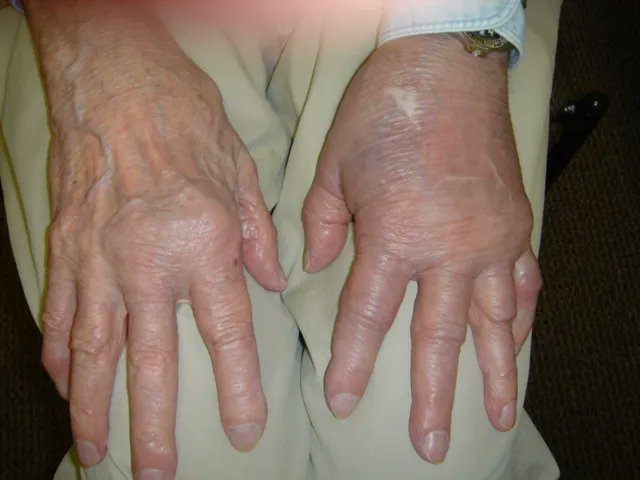 Multimorbidity, the presence of multiple overlapping chronic comorbid conditions, is increasingly common at first presentation of rheumatoid arthritis (RA), increasing as a person gets older and/or during disease progression. 

bit.ly/3p6qTnB
