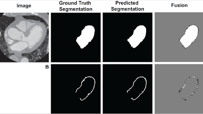 Radiology_AI's tweet photo. #Octree compression preserved image and segmentation features better than spatial downsampling https://t.co/8tGNNTBj1x @ContijochResLab @UCSDImaging @UCSDJacobs #CVRad #HeartCT #ML https://t.co/RiGSxmqhkE