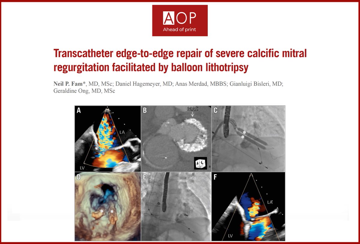 "Transcatheter edge-to-edge repair of severe calcific mitral regurgitation facilitated by balloon lithotripsy" by Fam N, et al. #EAPCI ow.ly/plwz50GXjJ0