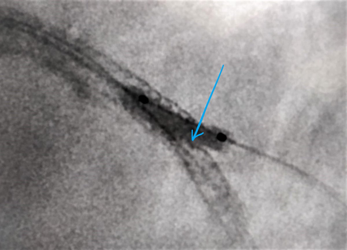 This is why you don't just 'open the side' @swissCTO @skat_ct @stefan_harb @evandrofilhobr @njohncamm @MarcMadalin @PCRonline @drandrewsharp @mirvatalasnag @gabor_gt