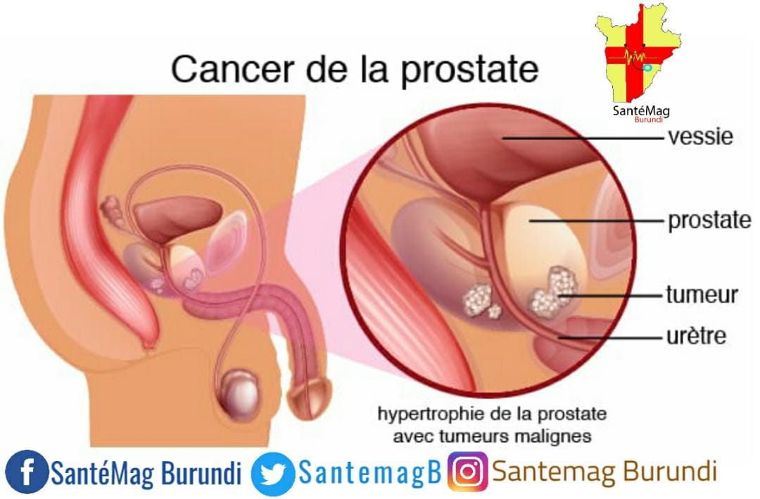 Enlarged prostate