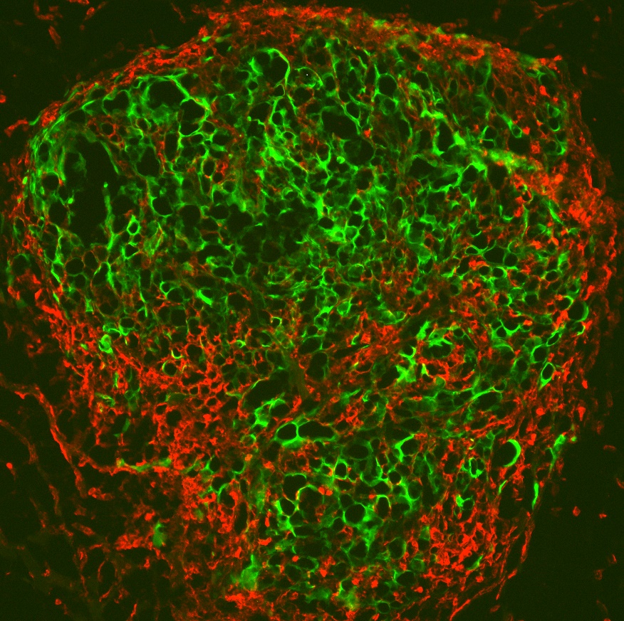 Mount Sinai Tisch Cancer Center tweet media